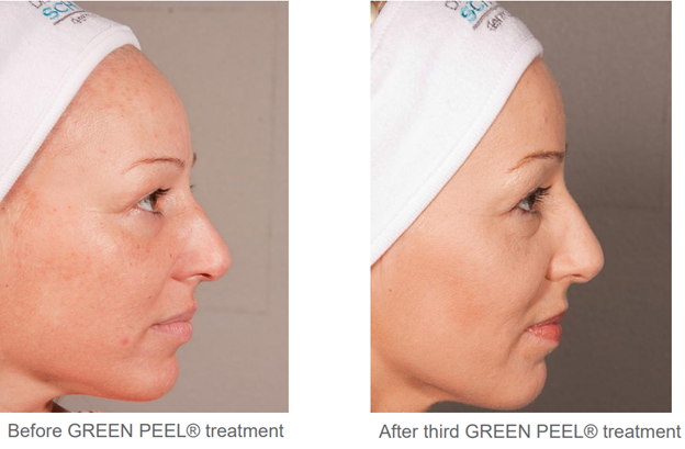Skin Treatments