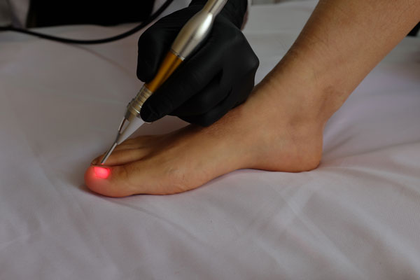 Laser Treatment