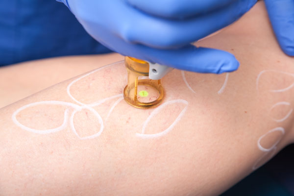 Laser Treatment